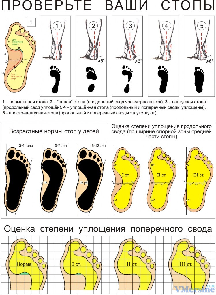 детское пласкостопие